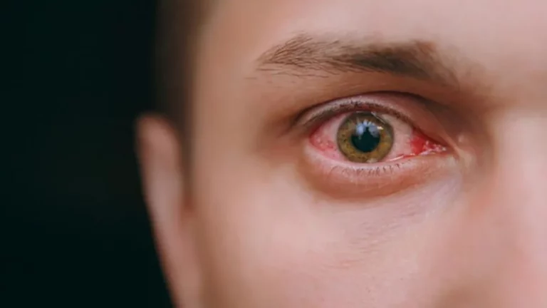 eye and kidney