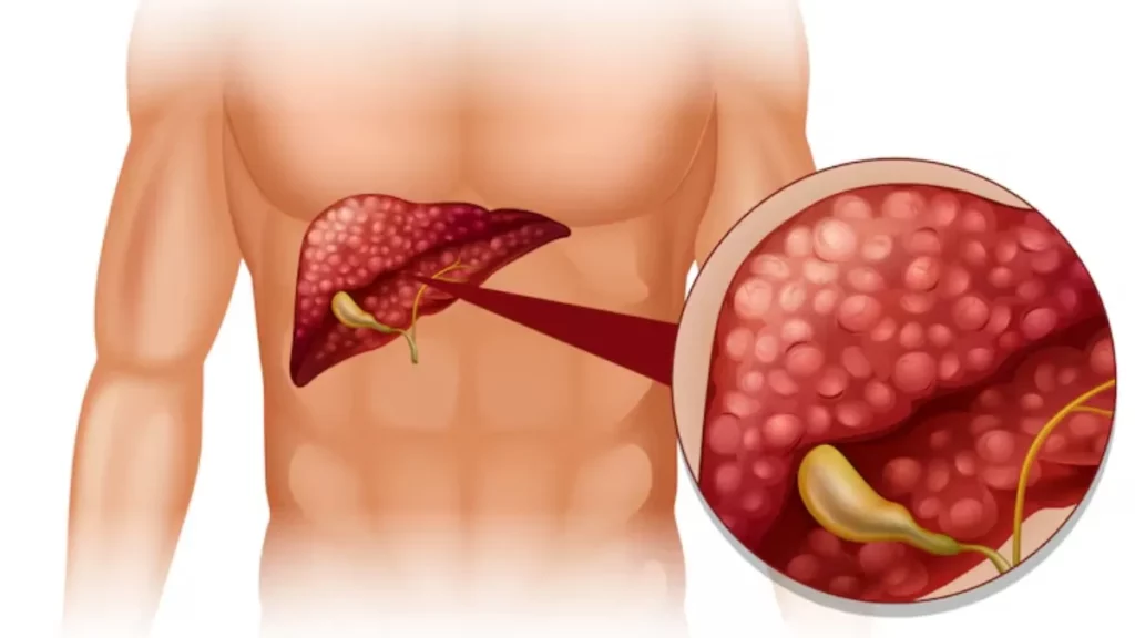 fatty liver and liver cancer progression chart
