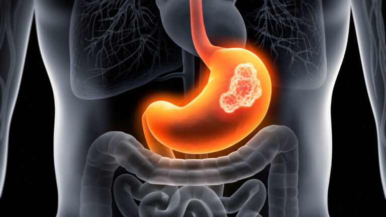 Over 15 Million People Born Between 2008 And 2017 Could Be At Risk Of Gastric Cancer, Warns Study
