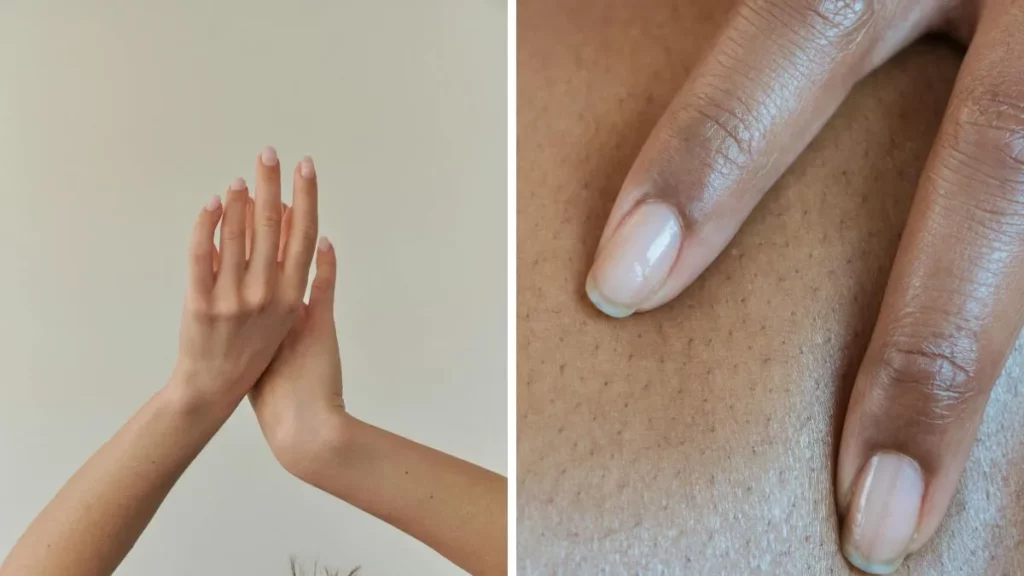 Pale nails showing iron deficiency - nail colour deficiency warning